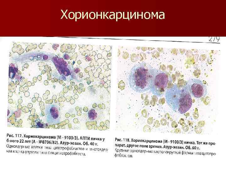 Хорионкарцинома 