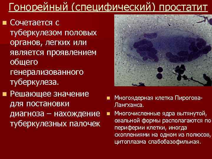 Гонорейный (специфический) простатит Сочетается с туберкулезом половых органов, легких или является проявлением общего генерализованного