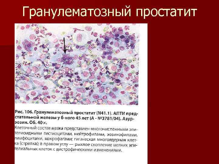 Гранулематозный простатит 