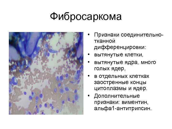 Фибросаркома • Признаки соединительнотканной дифференцировки: • вытянутые клетки, • вытянутые ядра, много голых ядер,