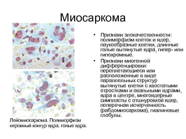 Миосаркома Лейомиосаркома. Полиморфизм неровный контур ядра, голые ядра. • Признаки злокачественности: полиморфизм клеток и