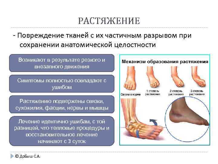 РАСТЯЖЕНИЕ - Повреждение тканей с их частичным разрывом при сохранении анатомической целостности Возникают в