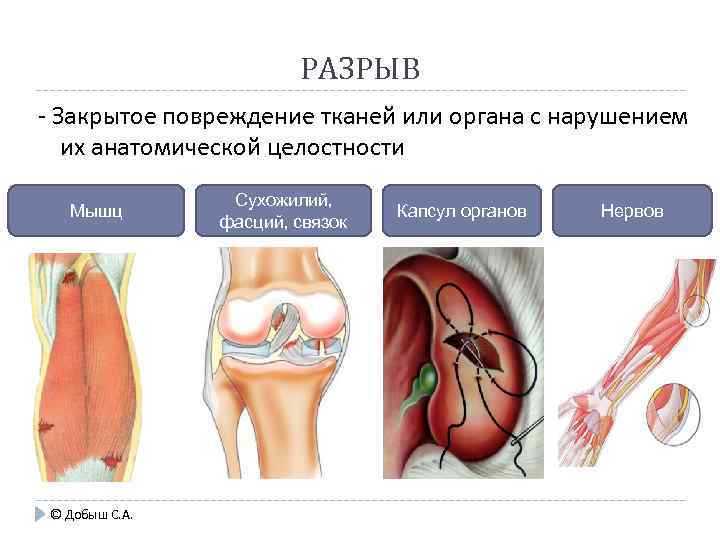РАЗРЫВ - Закрытое повреждение тканей или органа с нарушением их анатомической целостности Мышц ©