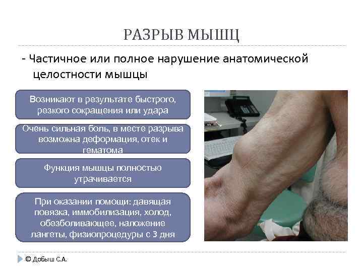 РАЗРЫВ МЫШЦ - Частичное или полное нарушение анатомической целостности мышцы Возникают в результате быстрого,