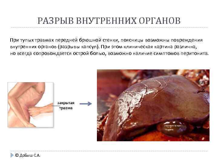 РАЗРЫВ ВНУТРЕННИХ ОРГАНОВ При тупых травмах передней брюшной стенки, поясницы возможны повреждения внутренних органов