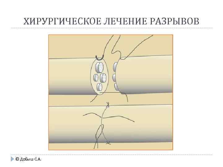 ХИРУРГИЧЕСКОЕ ЛЕЧЕНИЕ РАЗРЫВОВ © Добыш С. А. 