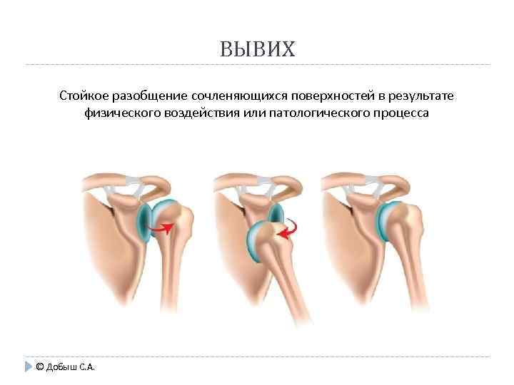 ВЫВИХ Стойкое разобщение сочленяющихся поверхностей в результате физического воздействия или патологического процесса © Добыш