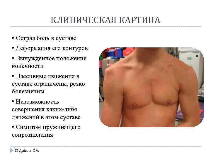 КЛИНИЧЕСКАЯ КАРТИНА • Острая боль в суставе • Деформация его контуров • Вынужденное положение