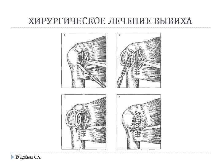 ХИРУРГИЧЕСКОЕ ЛЕЧЕНИЕ ВЫВИХА © Добыш С. А. 