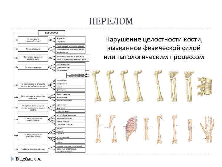 ПЕРЕЛОМ Нарушение целостности кости, вызванное физической силой или патологическим процессом © Добыш С. А.