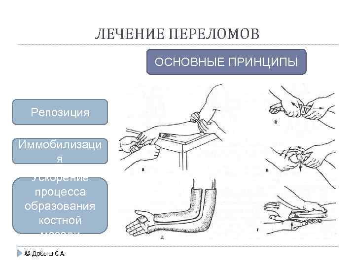ЛЕЧЕНИЕ ПЕРЕЛОМОВ ОСНОВНЫЕ ПРИНЦИПЫ Репозиция Иммобилизаци я Ускорение процесса образования костной мозоли © Добыш
