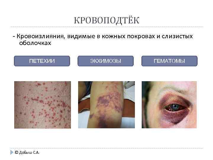 КРОВОПОДТЁК - Кровоизлияния, видимые в кожных покровах и слизистых оболочках ПЕТЕХИИ © Добыш С.