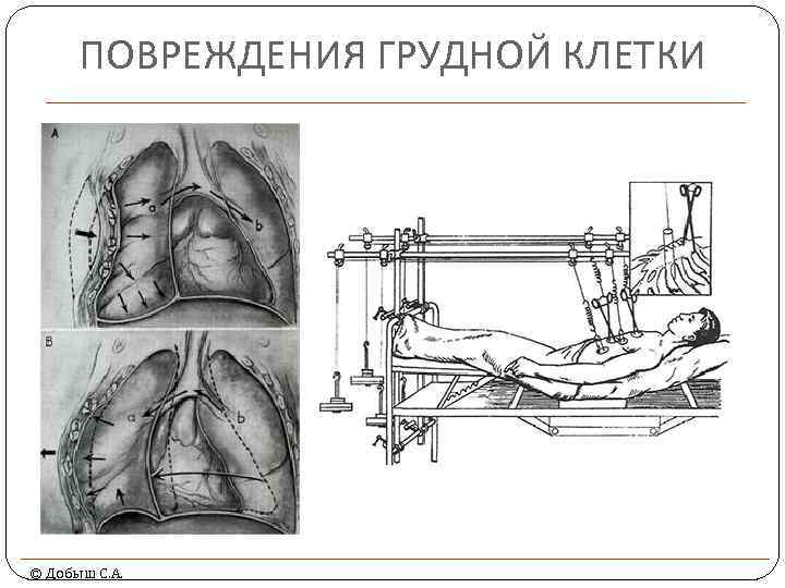 ПОВРЕЖДЕНИЯ ГРУДНОЙ КЛЕТКИ © Добыш С. А. 