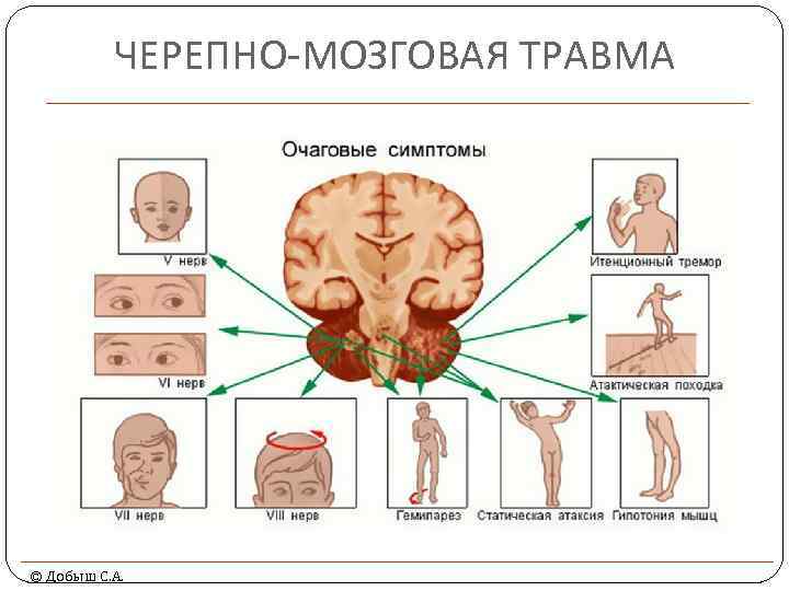 ЧЕРЕПНО-МОЗГОВАЯ ТРАВМА © Добыш С. А. 