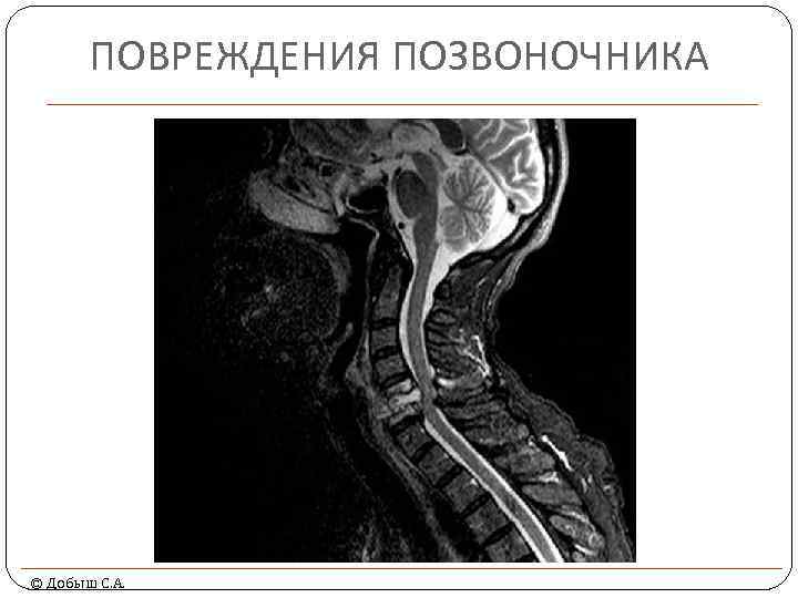 ПОВРЕЖДЕНИЯ ПОЗВОНОЧНИКА © Добыш С. А. 