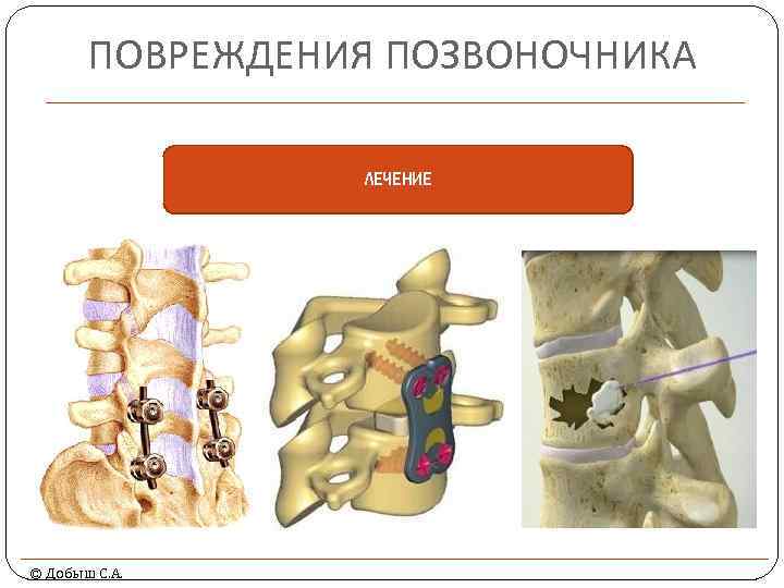 ПОВРЕЖДЕНИЯ ПОЗВОНОЧНИКА ЛЕЧЕНИЕ © Добыш С. А. 