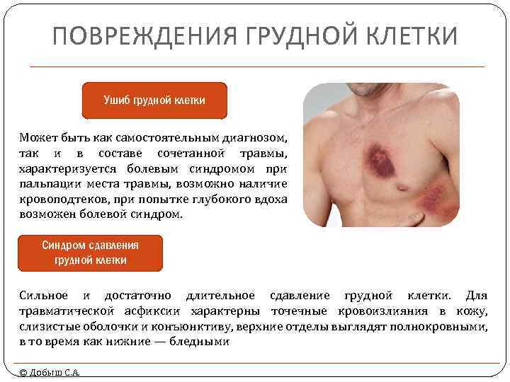 ПОВРЕЖДЕНИЯ ГРУДНОЙ КЛЕТКИ Ушиб грудной клетки Может быть как самостоятельным диагнозом, так и в