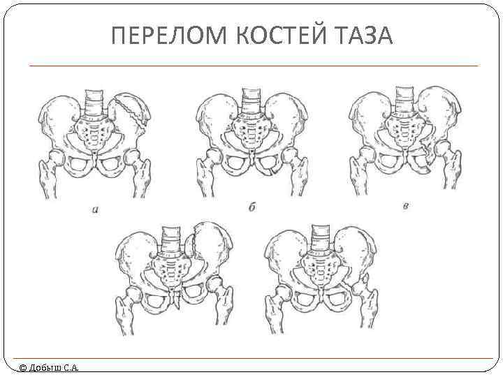 ПЕРЕЛОМ КОСТЕЙ ТАЗА © Добыш С. А. 