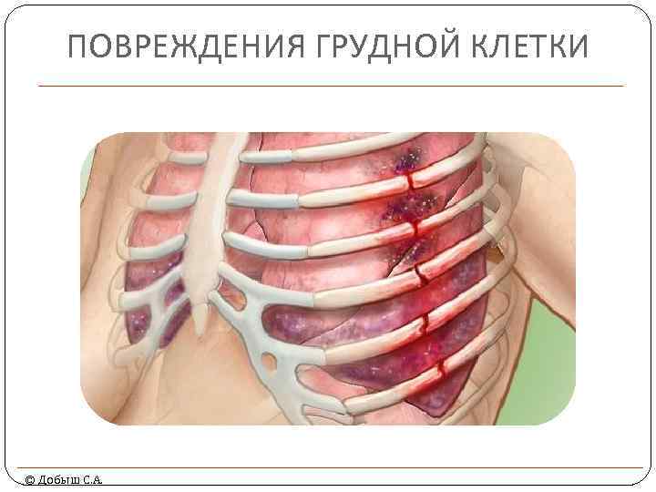 ПОВРЕЖДЕНИЯ ГРУДНОЙ КЛЕТКИ © Добыш С. А. 