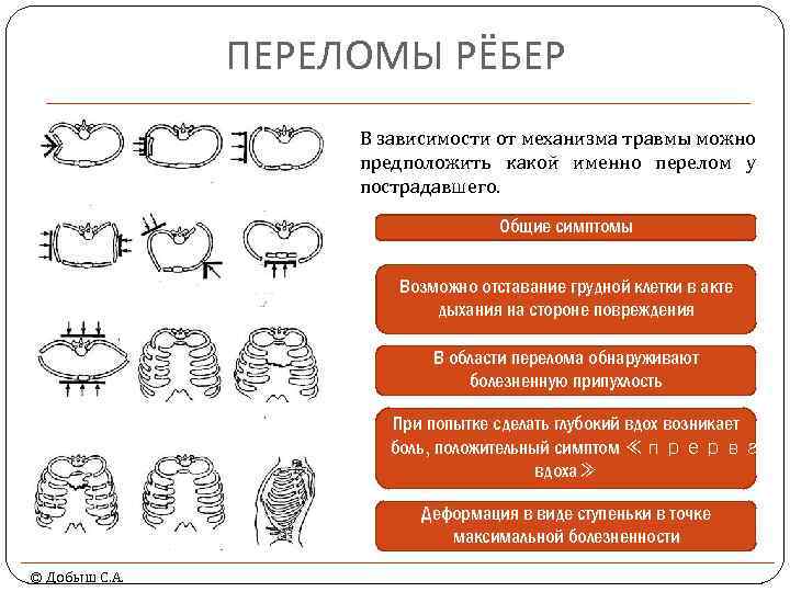 ПЕРЕЛОМЫ РЁБЕР В зависимости от механизма травмы можно предположить какой именно перелом у пострадавшего.