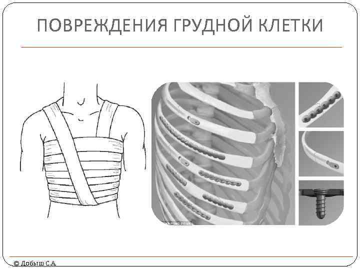 ПОВРЕЖДЕНИЯ ГРУДНОЙ КЛЕТКИ © Добыш С. А. 