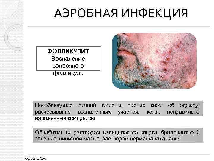 АЭРОБНАЯ ИНФЕКЦИЯ ФОЛЛИКУЛИТ Воспаление волосяного фолликула Несоблюдение личной гигиены, трение кожи об одежду, расчесывание