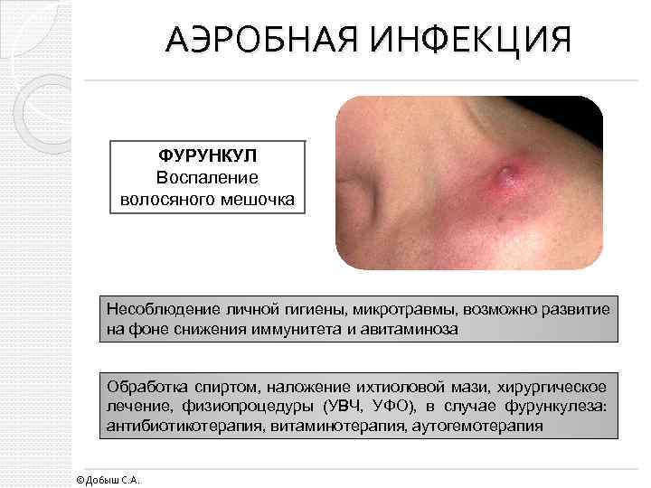АЭРОБНАЯ ИНФЕКЦИЯ ФУРУНКУЛ Воспаление волосяного мешочка Несоблюдение личной гигиены, микротравмы, возможно развитие на фоне