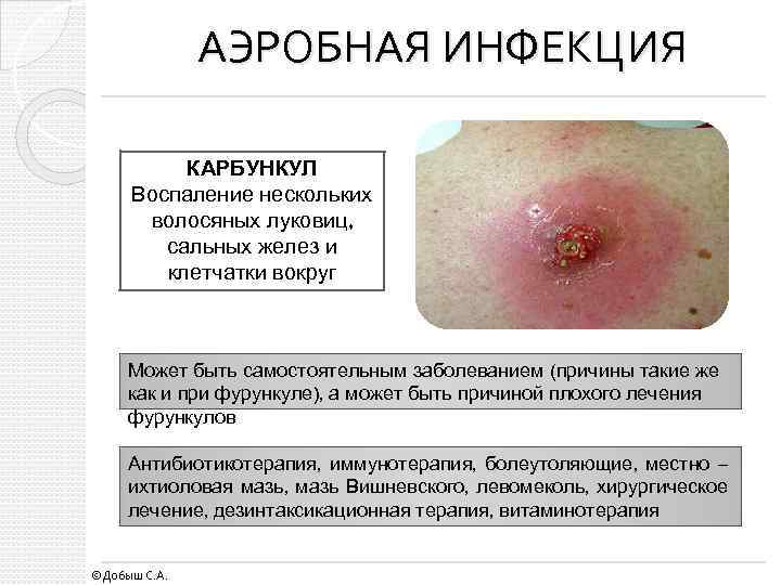 АЭРОБНАЯ ИНФЕКЦИЯ КАРБУНКУЛ Воспаление нескольких волосяных луковиц, сальных желез и клетчатки вокруг Может быть