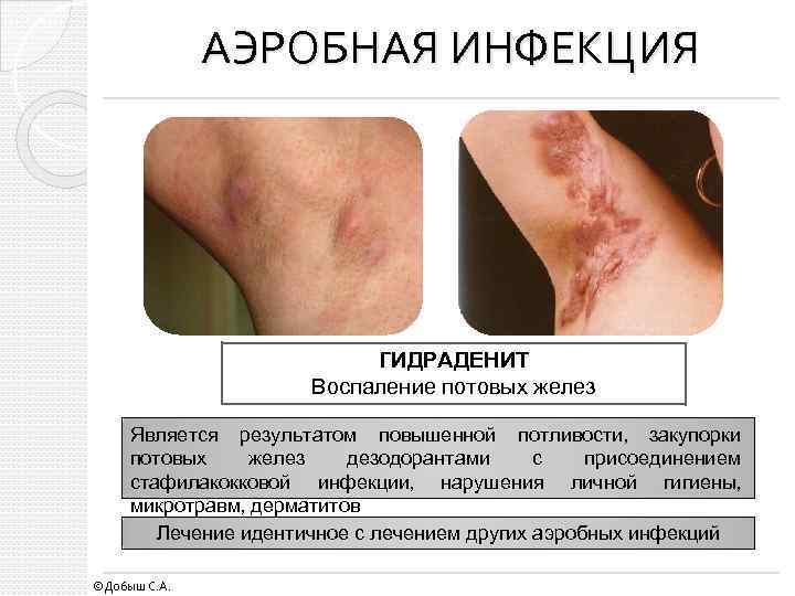 АЭРОБНАЯ ИНФЕКЦИЯ ГИДРАДЕНИТ Воспаление потовых желез Является результатом повышенной потливости, закупорки потовых желез дезодорантами