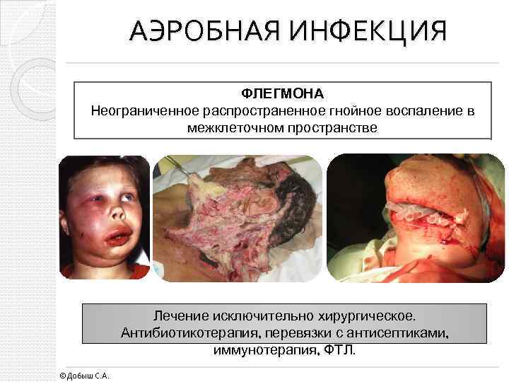 АЭРОБНАЯ ИНФЕКЦИЯ ФЛЕГМОНА Неограниченное распространенное гнойное воспаление в межклеточном пространстве Лечение исключительно хирургическое. Антибиотикотерапия,