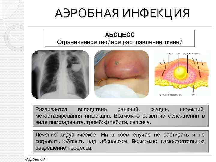АЭРОБНАЯ ИНФЕКЦИЯ АБСЦЕСС Ограниченное гнойное расплавление тканей Развивается вследствие ранений, ссадин, инъекций, метастазирования инфекции.
