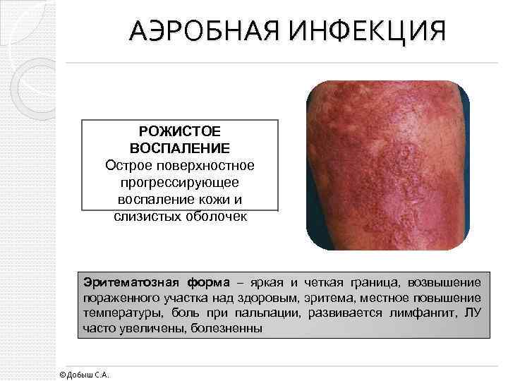АЭРОБНАЯ ИНФЕКЦИЯ РОЖИСТОЕ ВОСПАЛЕНИЕ Острое поверхностное прогрессирующее воспаление кожи и слизистых оболочек Эритематозная форма