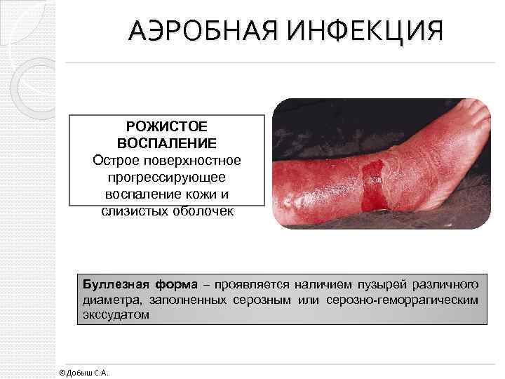 АЭРОБНАЯ ИНФЕКЦИЯ РОЖИСТОЕ ВОСПАЛЕНИЕ Острое поверхностное прогрессирующее воспаление кожи и слизистых оболочек Буллезная форма