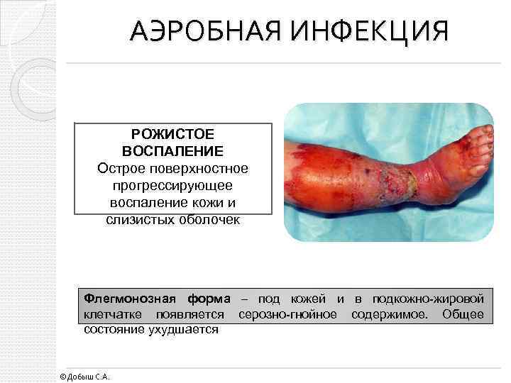 АЭРОБНАЯ ИНФЕКЦИЯ РОЖИСТОЕ ВОСПАЛЕНИЕ Острое поверхностное прогрессирующее воспаление кожи и слизистых оболочек Флегмонозная форма