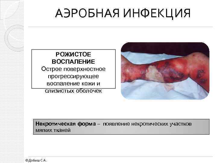 АЭРОБНАЯ ИНФЕКЦИЯ РОЖИСТОЕ ВОСПАЛЕНИЕ Острое поверхностное прогрессирующее воспаление кожи и слизистых оболочек Некротическая форма