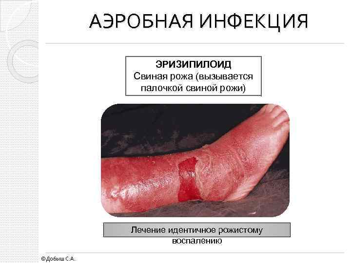 АЭРОБНАЯ ИНФЕКЦИЯ ЭРИЗИПИЛОИД Свиная рожа (вызывается палочкой свиной рожи) Лечение идентичное рожистому воспалению ©Добыш