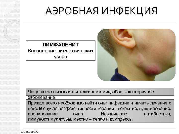 АЭРОБНАЯ ИНФЕКЦИЯ ЛИМФАДЕНИТ Воспаление лимфатических узлов Чаще всего вызывается токсинами микробов, как вторичное заболевание