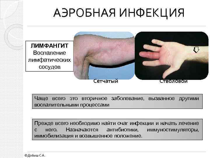 АЭРОБНАЯ ИНФЕКЦИЯ ЛИМФАНГИТ Воспаление лимфатических сосудов Сетчатый Стволовой Чаще всего это вторичное заболевание, вызванное