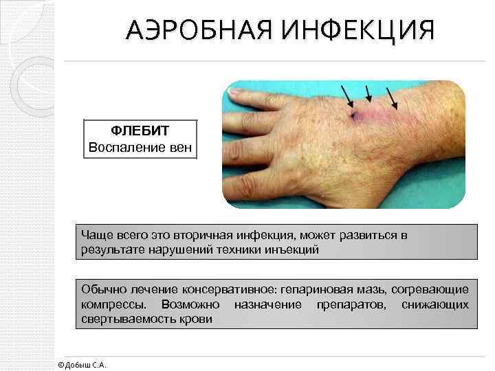 АЭРОБНАЯ ИНФЕКЦИЯ ФЛЕБИТ Воспаление вен Чаще всего это вторичная инфекция, может развиться в результате