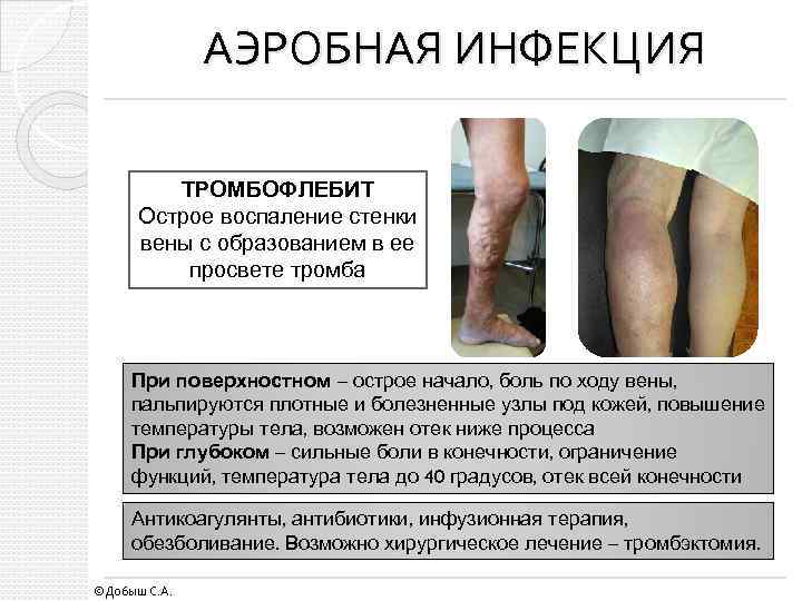 АЭРОБНАЯ ИНФЕКЦИЯ ТРОМБОФЛЕБИТ Острое воспаление стенки вены с образованием в ее просвете тромба При