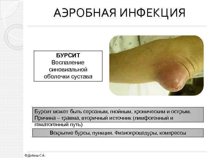 АЭРОБНАЯ ИНФЕКЦИЯ БУРСИТ Воспаление синовиальной оболочки сустава Бурсит может быть серозным, гнойным, хроническим и