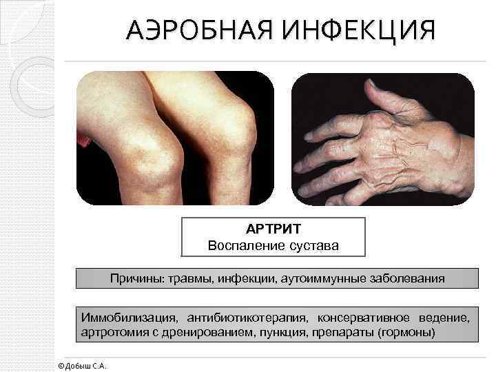 АЭРОБНАЯ ИНФЕКЦИЯ АРТРИТ Воспаление сустава Причины: травмы, инфекции, аутоиммунные заболевания Иммобилизация, антибиотикотерапия, консервативное ведение,