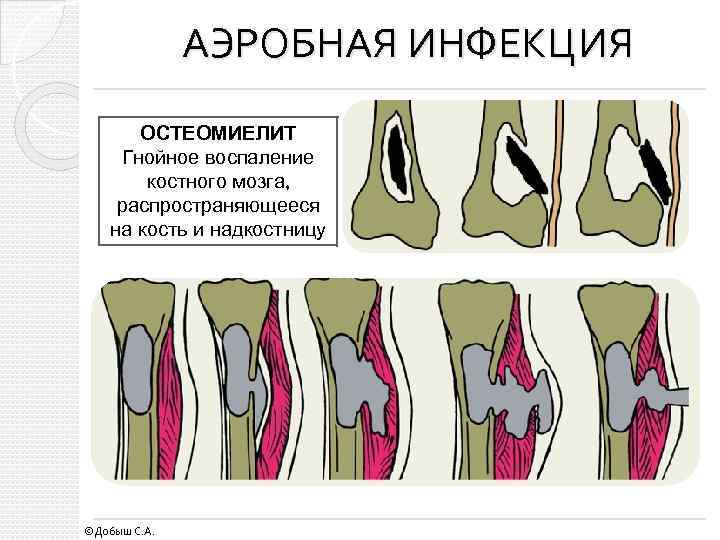 АЭРОБНАЯ ИНФЕКЦИЯ ОСТЕОМИЕЛИТ Гнойное воспаление костного мозга, распространяющееся на кость и надкостницу ©Добыш С.