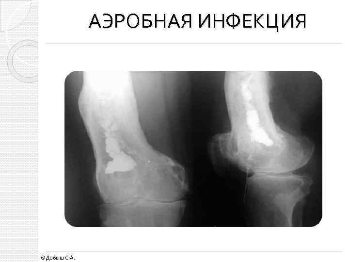 АЭРОБНАЯ ИНФЕКЦИЯ ©Добыш С. А. 