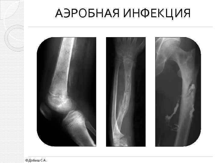 АЭРОБНАЯ ИНФЕКЦИЯ ©Добыш С. А. 