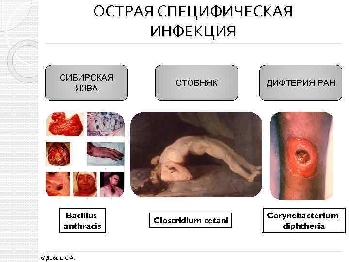 ОСТРАЯ СПЕЦИФИЧЕСКАЯ ИНФЕКЦИЯ СИБИРСКАЯ ЯЗВА Bacillus anthracis ©Добыш С. А. СТОБНЯК Clostridium tetani ДИФТЕРИЯ