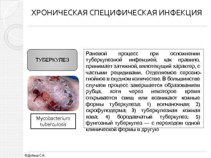 ХРОНИЧЕСКАЯ СПЕЦИФИЧЕСКАЯ ИНФЕКЦИЯ ТУБЕРКУЛЕЗ Mycobacterium tuberculosis ©Добыш С. А. Раневой процесс при осложнении туберкулезной