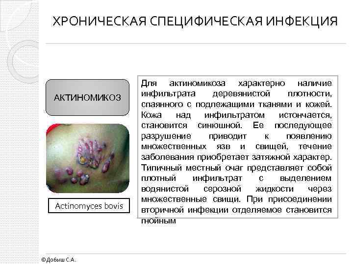 ХРОНИЧЕСКАЯ СПЕЦИФИЧЕСКАЯ ИНФЕКЦИЯ АКТИНОМИКОЗ Actinomyces bovis ©Добыш С. А. Для актиномикоза характерно наличие инфильтрата
