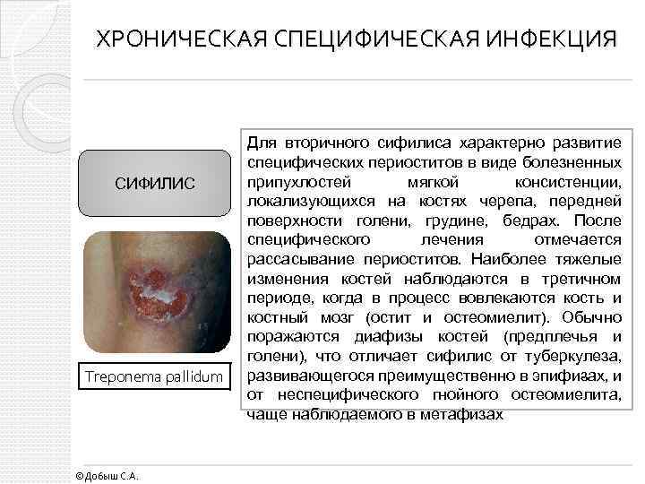ХРОНИЧЕСКАЯ СПЕЦИФИЧЕСКАЯ ИНФЕКЦИЯ СИФИЛИС Treponema pallidum ©Добыш С. А. Для вторичного сифилиса характер о