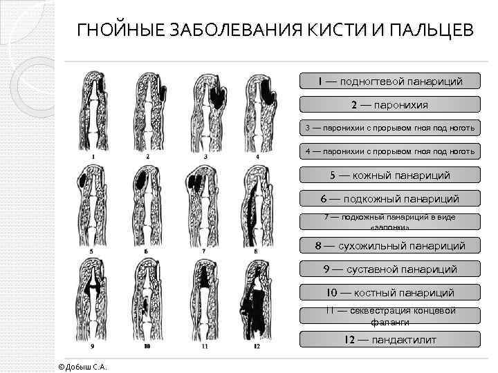 ГНОЙНЫЕ ЗАБОЛЕВАНИЯ КИСТИ И ПАЛЬЦЕВ 1 — подногтевой панариций 2 — паронихия 3 —